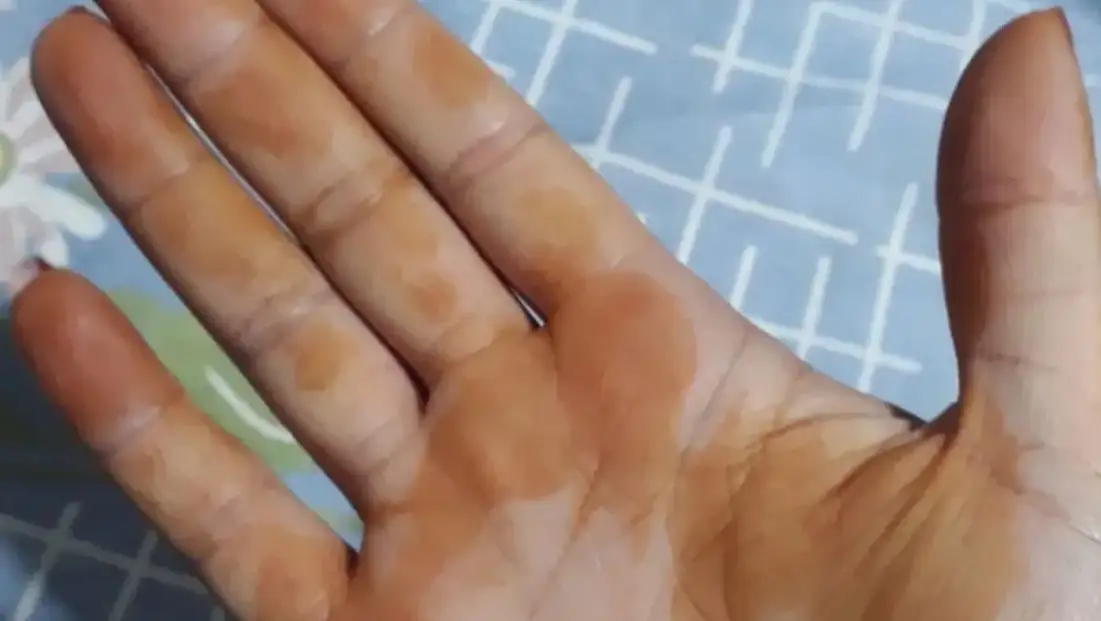 TV9 WHATSAPP İHBAR HATTINA GELEN İLGİNÇ FOTOĞRAF: “SABAH UYANDIĞIMDA ELİM BU HALE GELDİ”