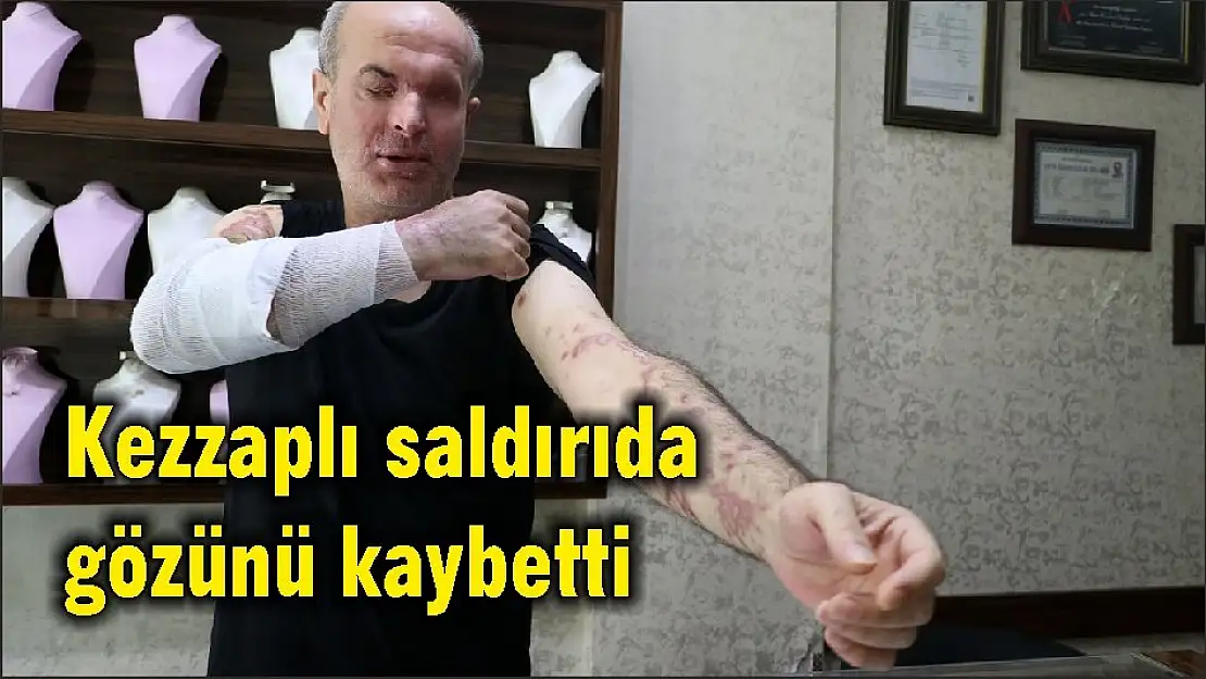 Kezzaplı saldırıda gözünü kaybetti