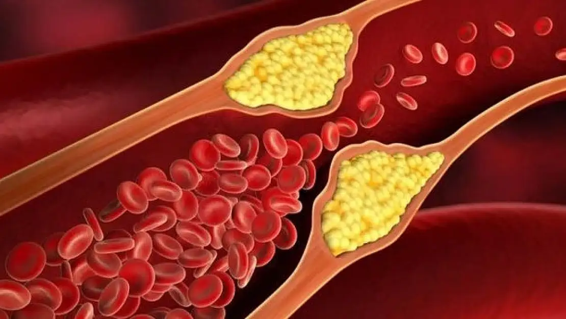 Kolesterol yüksekliğinin nedenleri nelerdir?