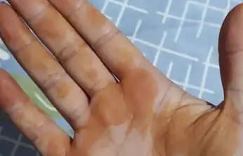 TV9 WHATSAPP İHBAR HATTINA GELEN İLGİNÇ FOTOĞRAF: 'SABAH UYANDIĞIMDA ELİM BU HALE GELDİ'