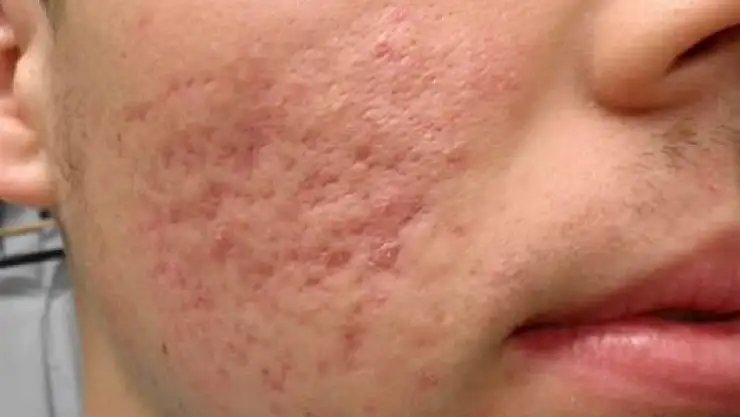 Sivilce lekesi iyileşir mi?