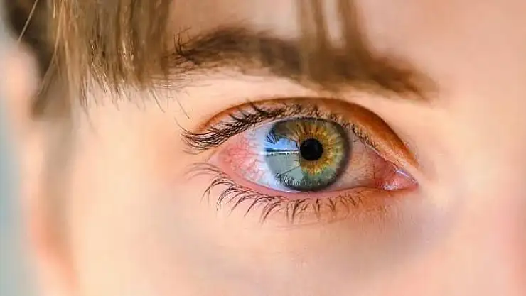 Göz Yanması Neden Olur? Uzmanlardan Uyarı: Ekran Başında Fazla Kalmayın!