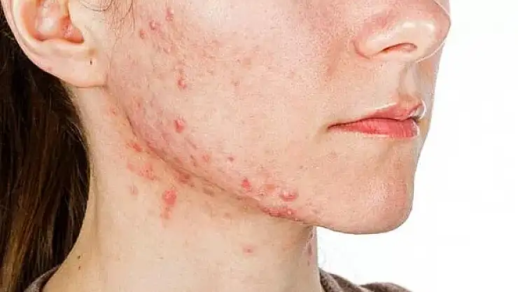 Sivilceye neden olan besinler nelerdir?