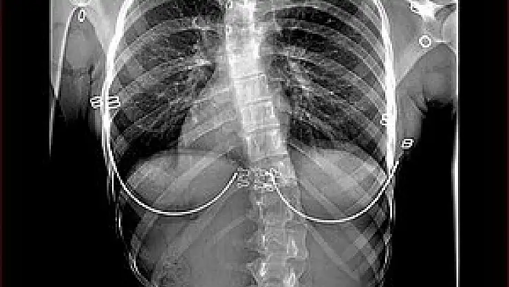 Skolyoz nasıl düzelir?