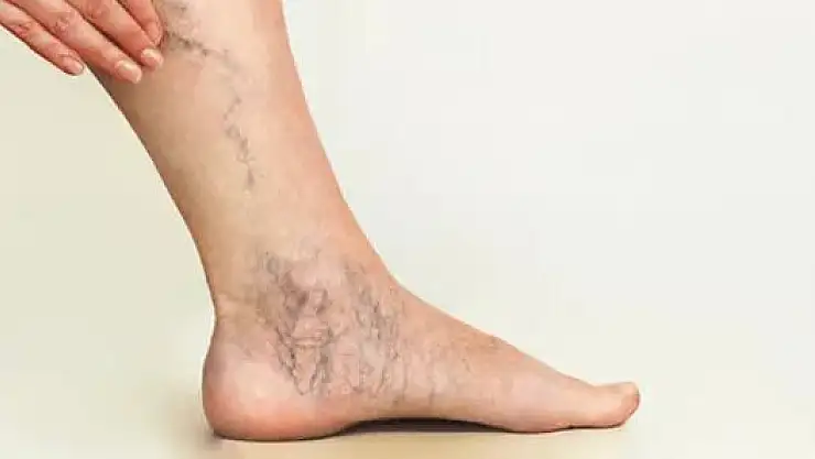 Varis için neler yapılabilir?