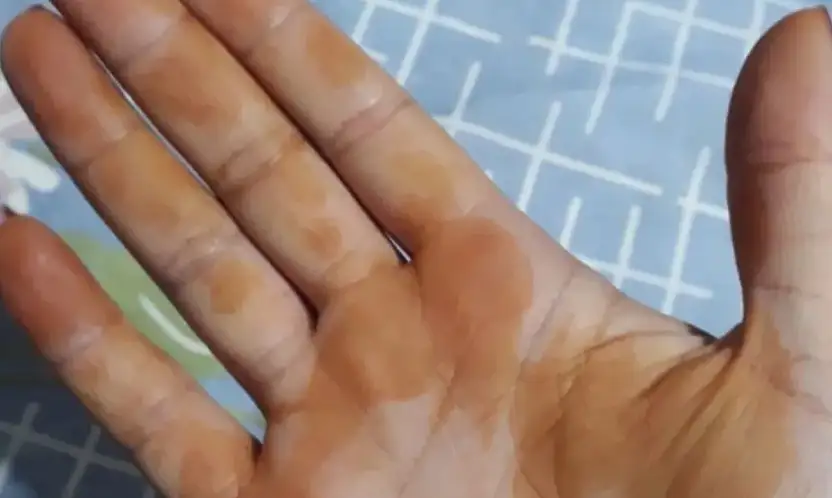 TV9 WHATSAPP İHBAR HATTINA GELEN İLGİNÇ FOTOĞRAF: 'SABAH UYANDIĞIMDA ELİM BU HALE GELDİ'